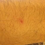 Google-Pixel-Watch-2-skin-irritation-1