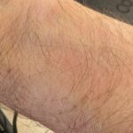 Google-Pixel-Watch-2-skin-irritation-2