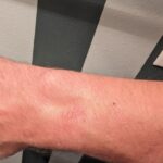 Google-Pixel-Watch-2-skin-irritation-4