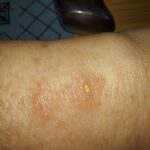 Google-Pixel-Watch-2-skin-irritation-6