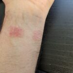 Pixel-Watch-2-band-causing-skin-irritation-2